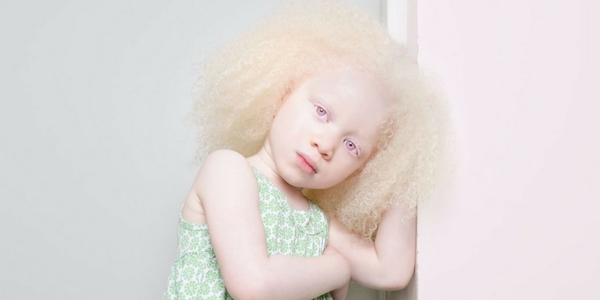 Wie wird Albinismus (Albino) behandelt?